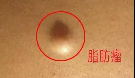 脂肪瘤严不严重?危害大不大,还得看这些!(图1)