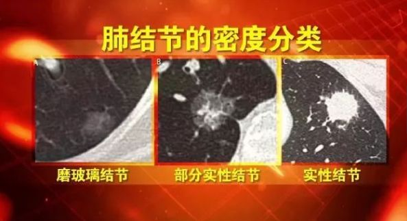 每5人就有1人查出肺结节!肺小结节离癌有多远?(图2)