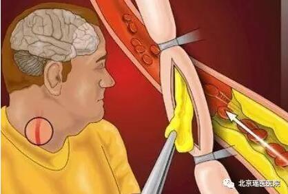 人过三十五，就怕血管堵，颈动脉狭窄年轻化，不容小觑(图1)