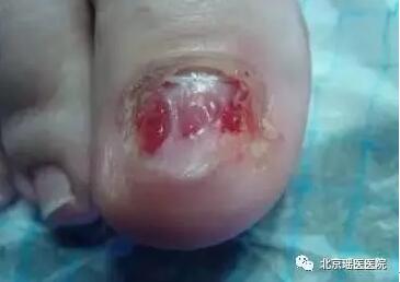 指甲上也能反映出的肿瘤信号，只是被很多人忽视了(图4)