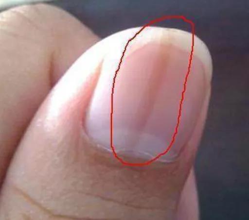 手指甲长这样,可能是肝脏在“求救”!(图2)