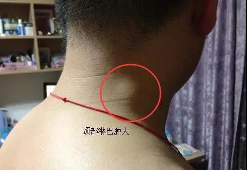 癌细胞发生转移的四个方式！做好以下五点，癌症远离你(图3)