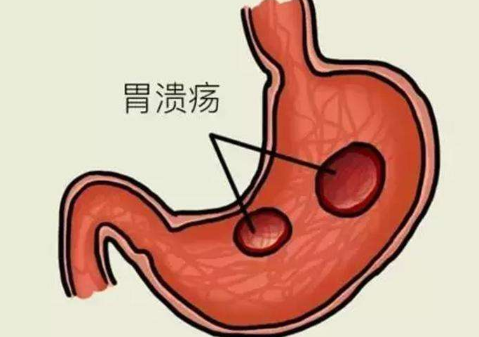 别等“胃病”拖成“胃癌”!这4种小病,最好及时治疗(图2)